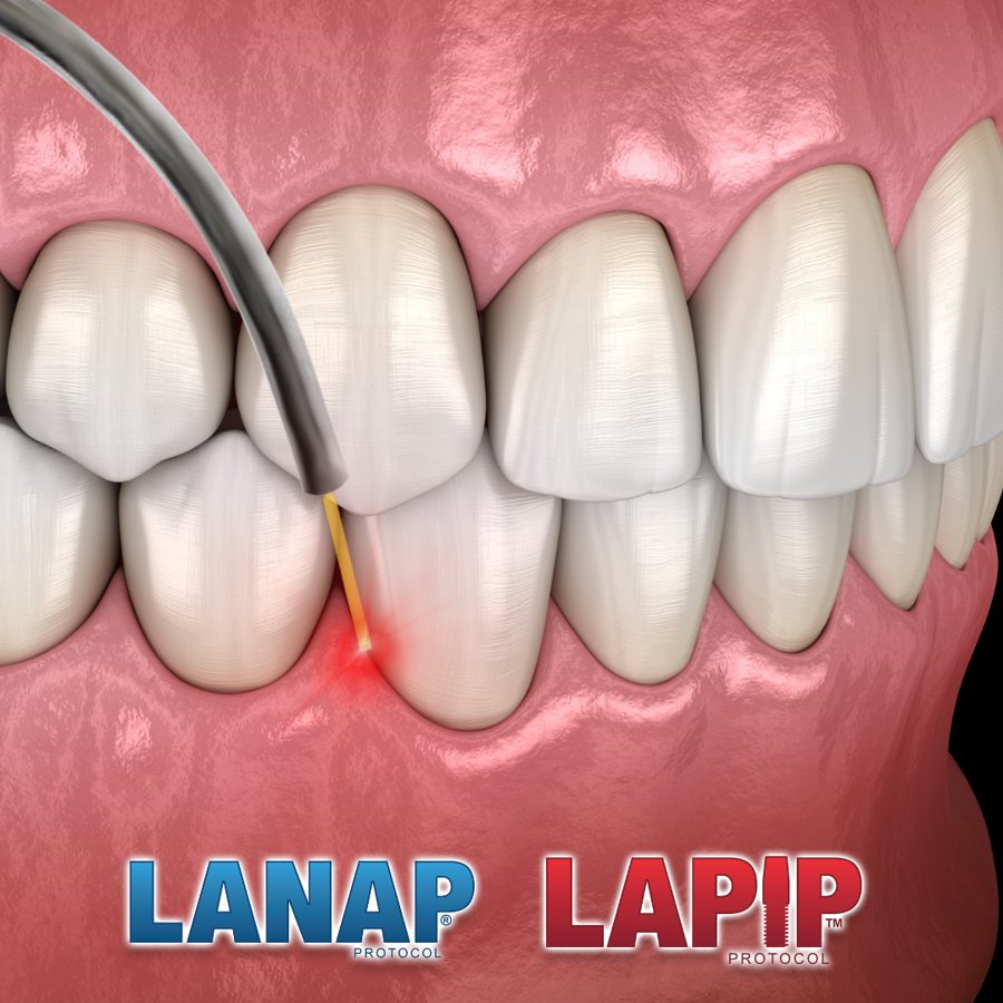 LANAP protocol certified provider