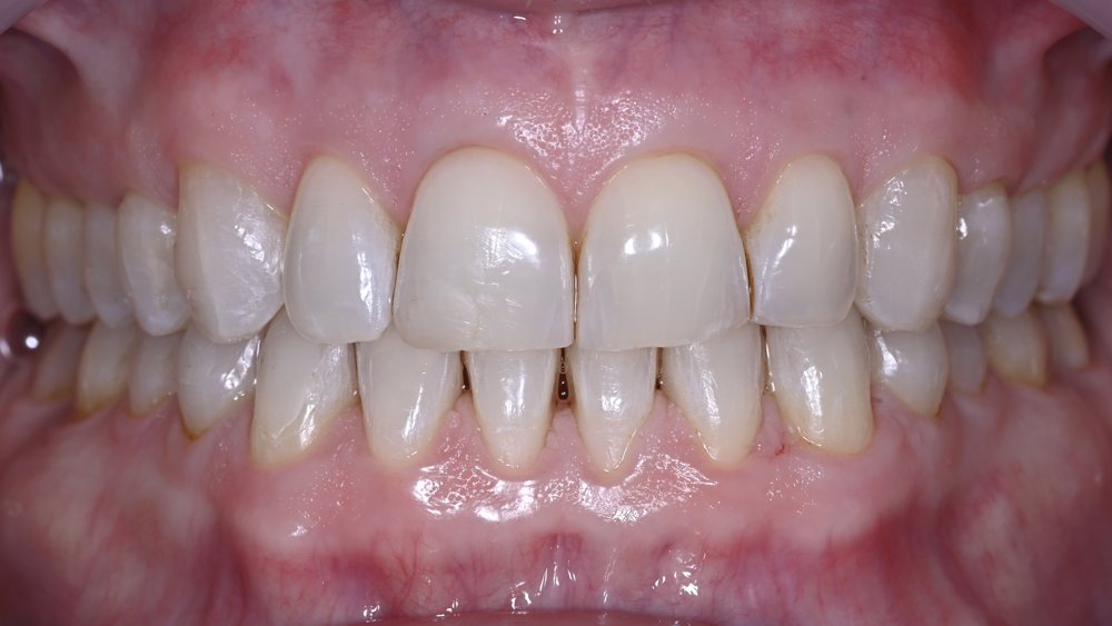 Gum line after Pinhole Surgical Technique