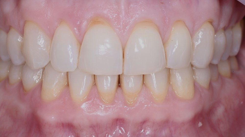 Gum recession before Pinhole Surgical Technique
