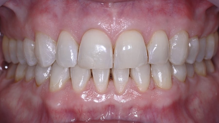 Gum line after Pinhole Surgical Technique