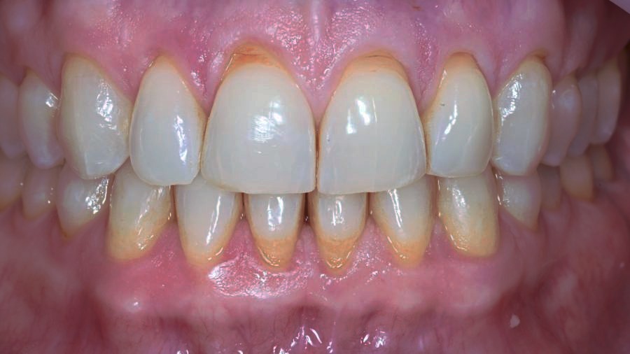 Gum recession before Pinhole Surgical Technique